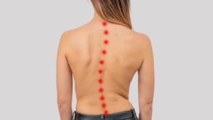 Cirurgia de Escoliose: Liberte-se da Curvatura