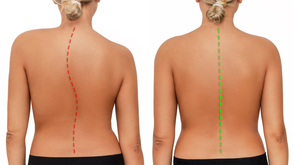 Uma coluna antes e depois da cirurgia de escoliose.